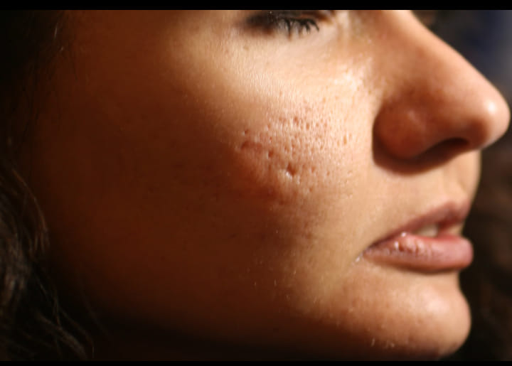 සම මත ඇති වන ඇති වන කැලැල්   ❇️   Acne scars 
