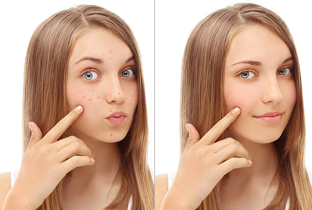 How to care an acne prone skin 