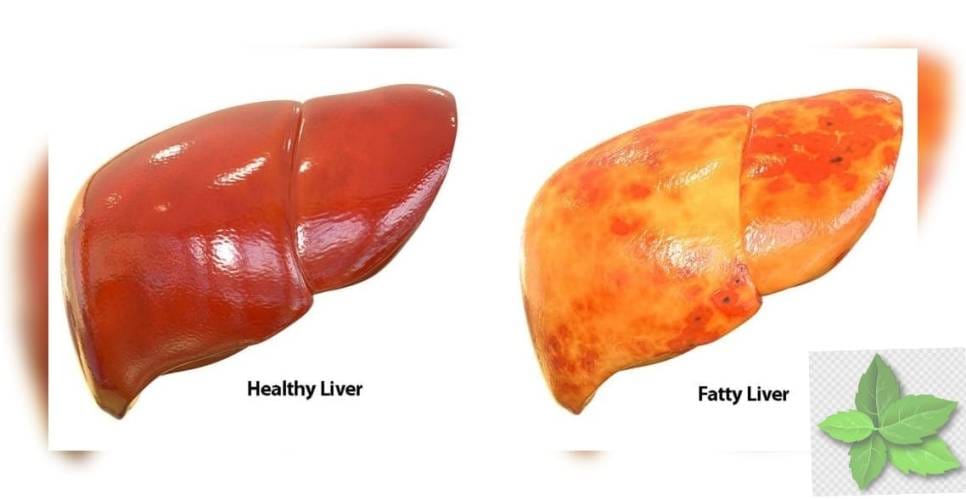 අක්මාවේ තෙල් තැම්පත්වීම හෙවත් Fatty Liver සුව කර ගන්නා අයුරු.